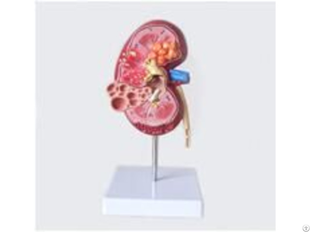 Jy A6098 Diseased Kidney