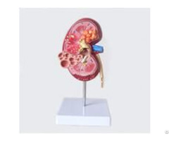 Jy A6098 Diseased Kidney