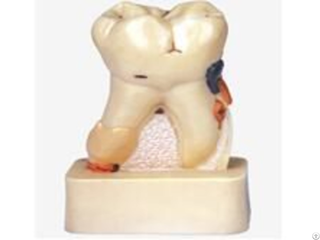 Jy B10008 Dissected Of Dental Disease