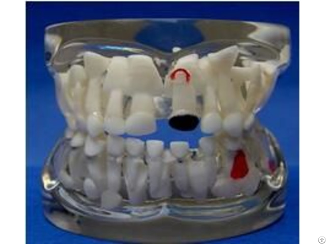 Jy B10013 Transparent Milk Teeth Pathology Model