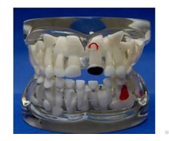 Jy B10013 Transparent Milk Teeth Pathology Model