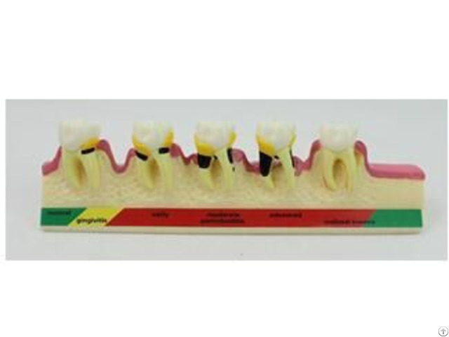 Jy B10014 Periodontal Disease Model