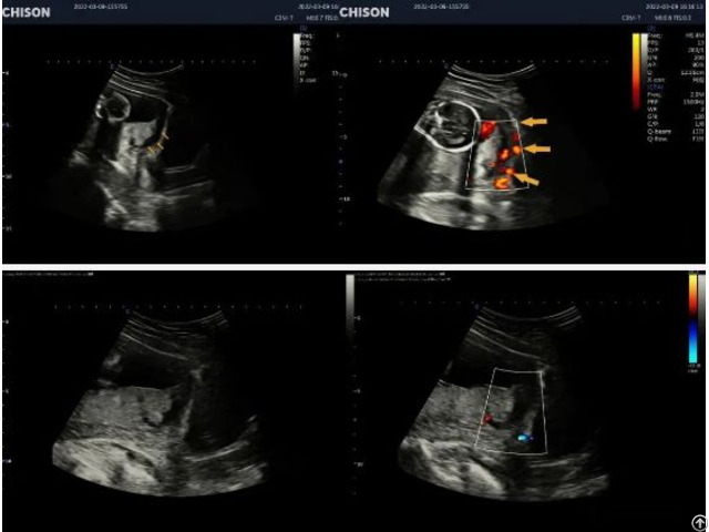 Placental Abruption Ultrasound