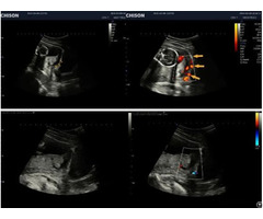 Placental Abruption Ultrasound