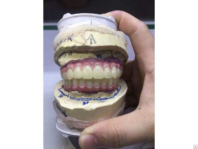 Fixed Permanent Implant Supported Dentures