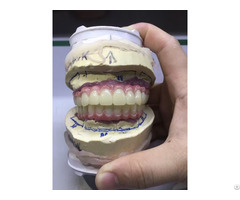 Fixed Permanent Implant Supported Dentures