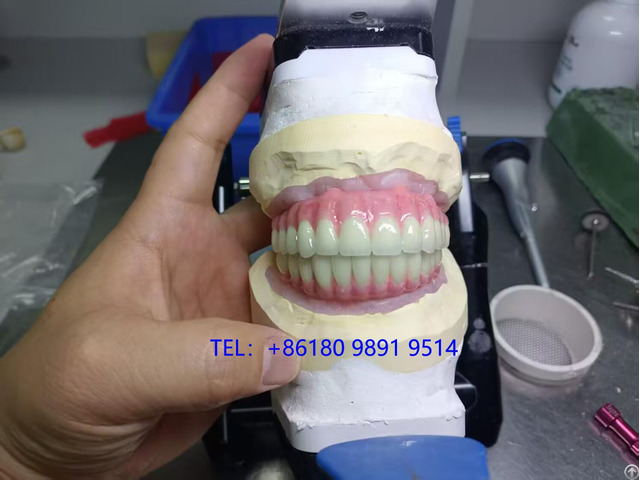 Implant Retained Hybrid Dentures