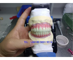 Implant Retained Hybrid Dentures