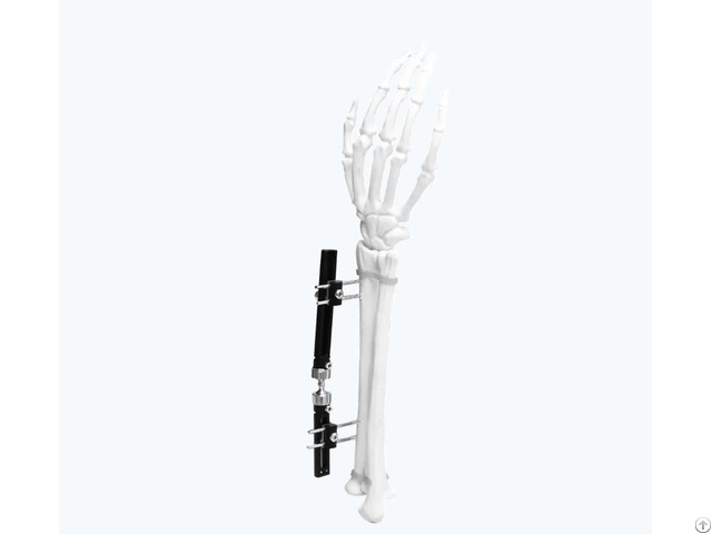 Wrist External Fixator
