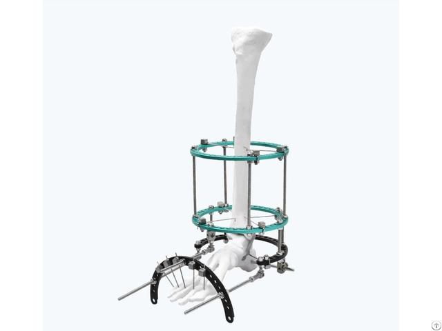 Complex Foot Deformity Ilizarov Fixator