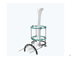 Complex Foot Deformity Ilizarov Fixator