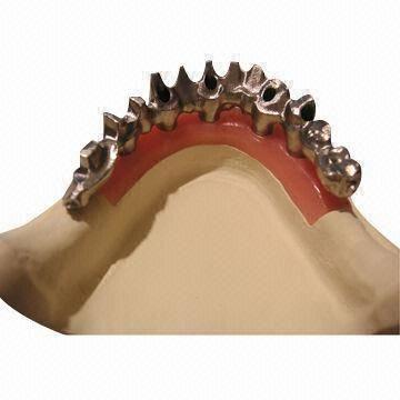 Cement Retained Bridge Implant Zirconium Alumina Valplast