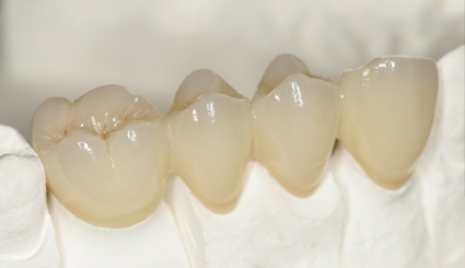 Dental Porcelain Fused To Metal Crown Titanium Alloy Pfm