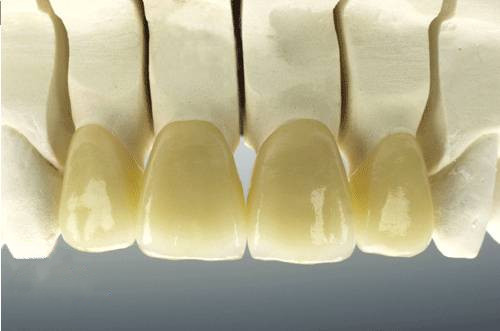 Dental Porcelain Fused To Pure Titanium Crown Pfm