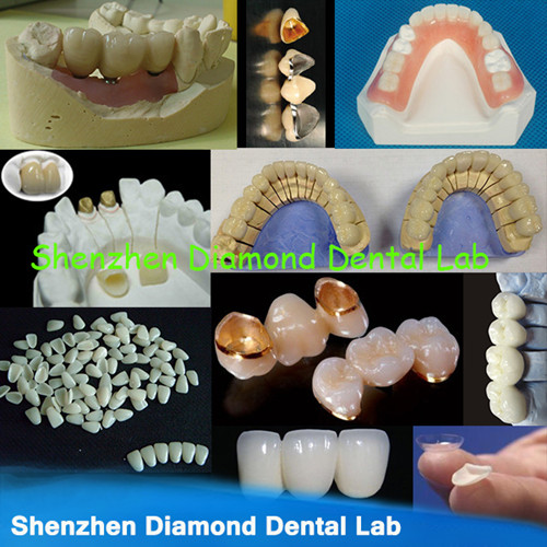 Dental Zirconia Pfm Metal Crowns And Implant Orthodontic Applinces