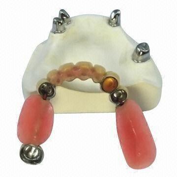 Telescope Denture Zirconium Alumina Valplas