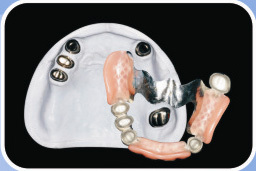 5 Telescopic Inner And Outer Crowns Primary Crow Non Precious Secondary Cro