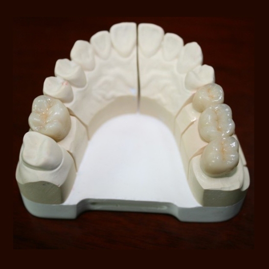 Dental Ips E Max All Ceramic Crown Casting Porcelain Bridge