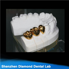 Dental Precous Metal Crowns