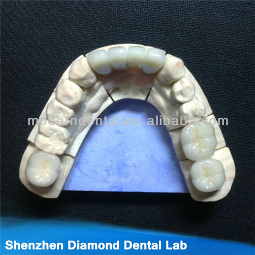 Dental Zirconia Weiland Crowns